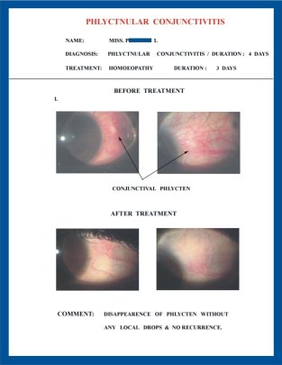 Phlyctenular Conjunctivitis